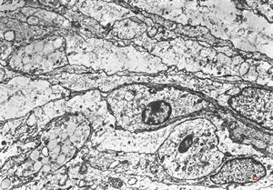 F,75y. | meningotheliomatous meningeoma F,75y. | meningotheliomatous meningeoma